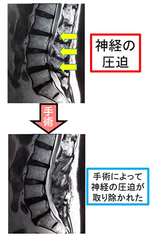 除圧術による狭窄の改善