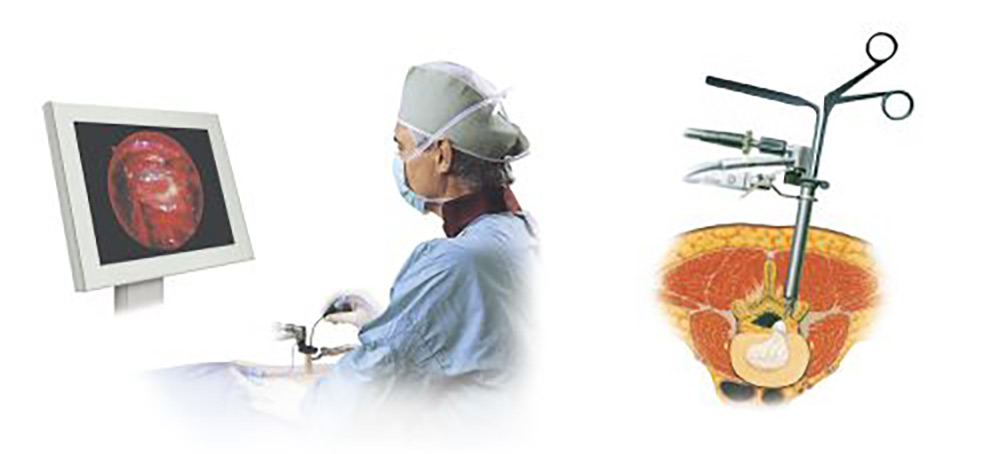 椎間板ヘルニアに対する内視鏡的ヘルニア摘出術（MED）