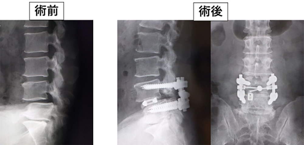 腰椎変性すべり症に対する腰椎後方椎体間固定術