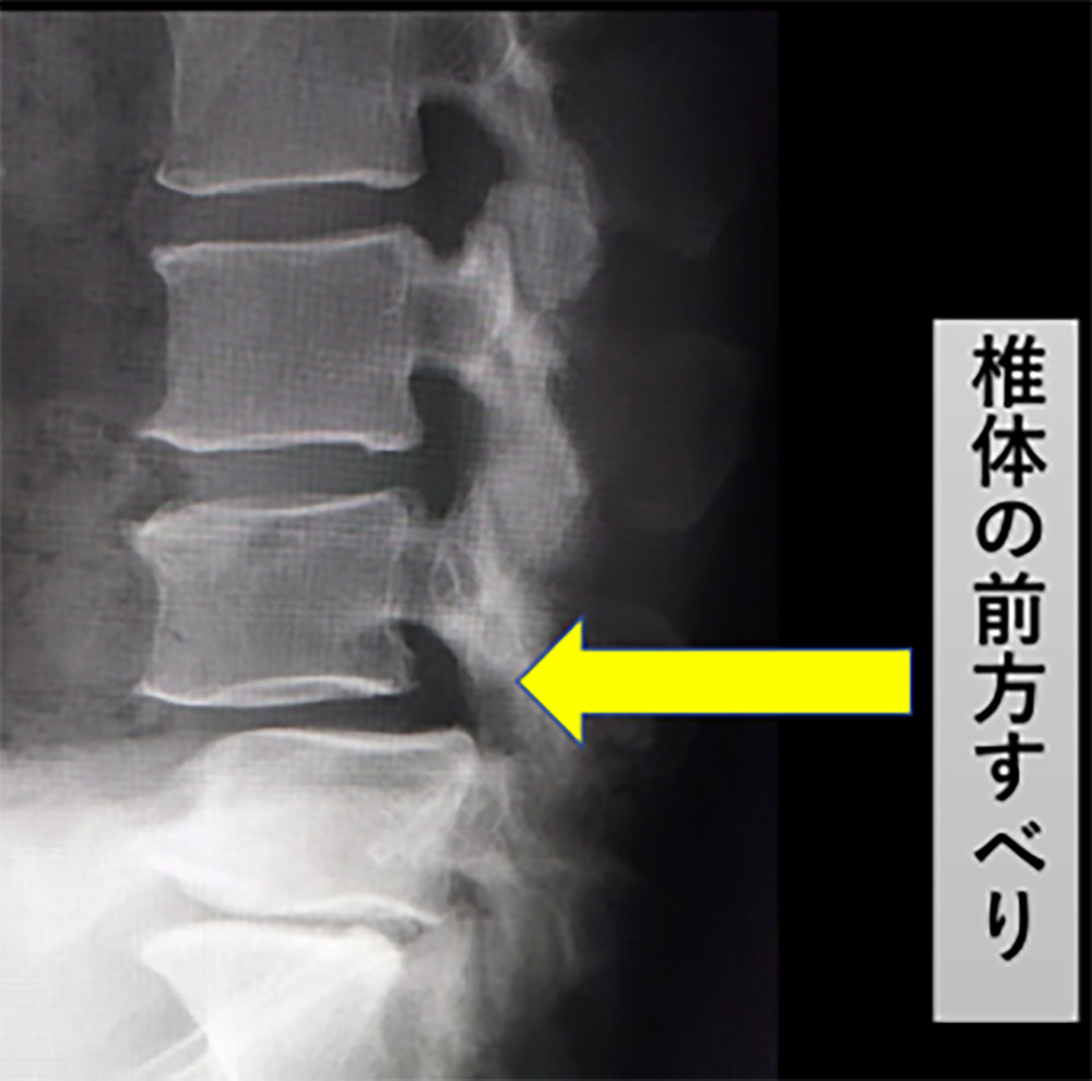 不安定性のある腰椎変性すべり症のレントゲン像