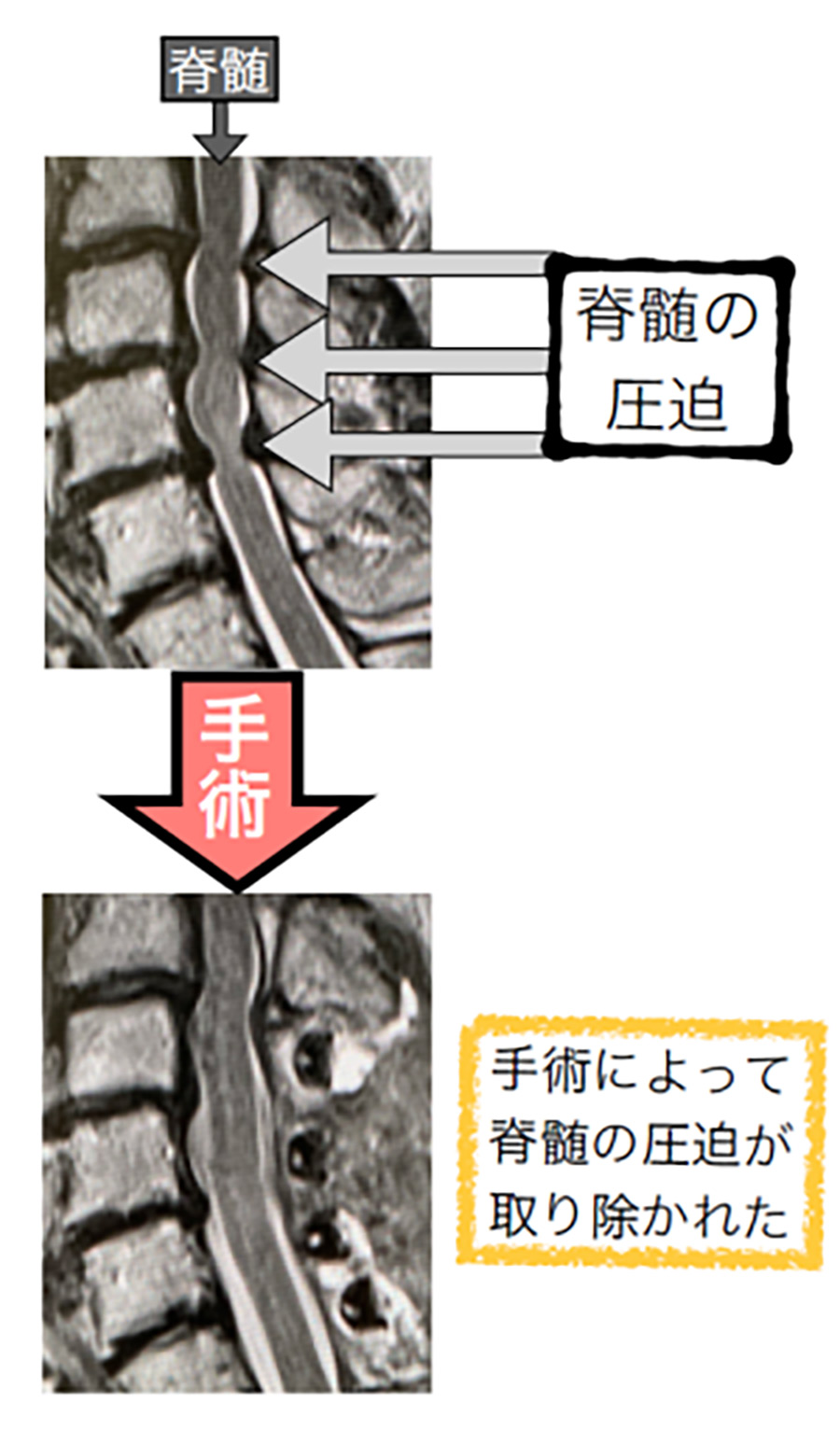 頚椎症性脊髄症の手術前後のMRI像