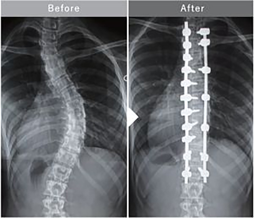 特発性思春期側弯症に対する後方矯正固定術