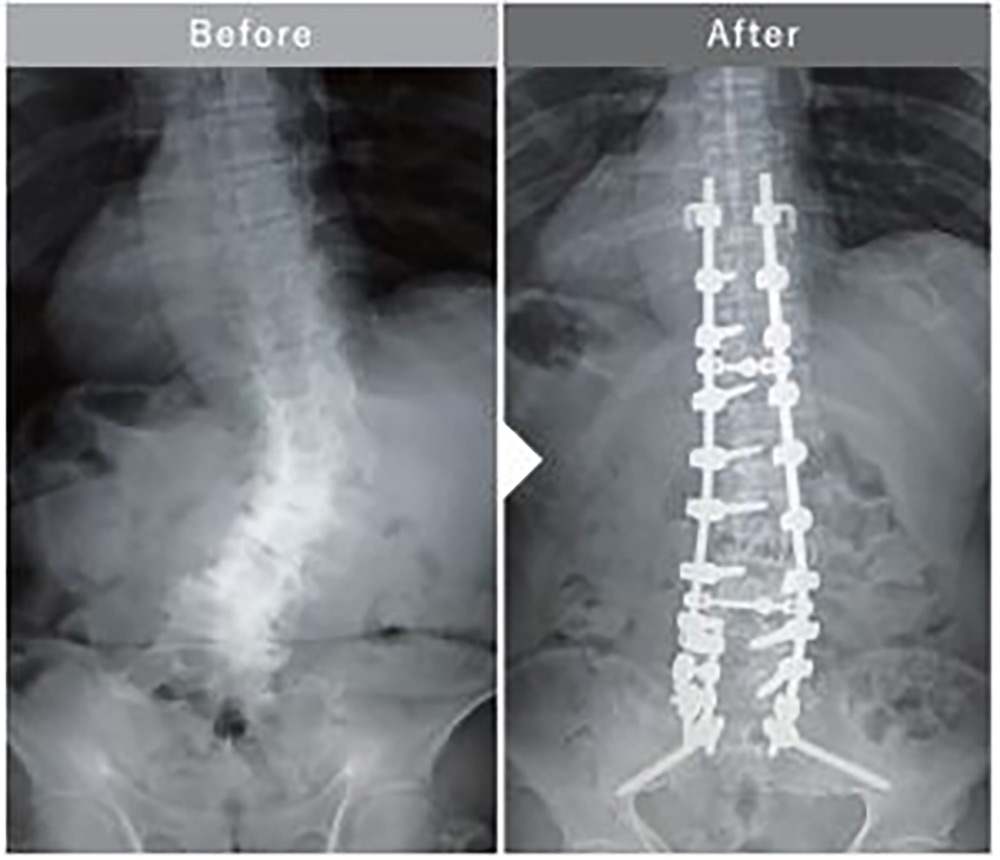 成人脊柱変形に対する胸腰仙椎矯正固定術