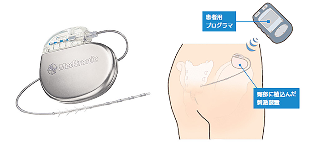 体内に植込んだ刺激装置