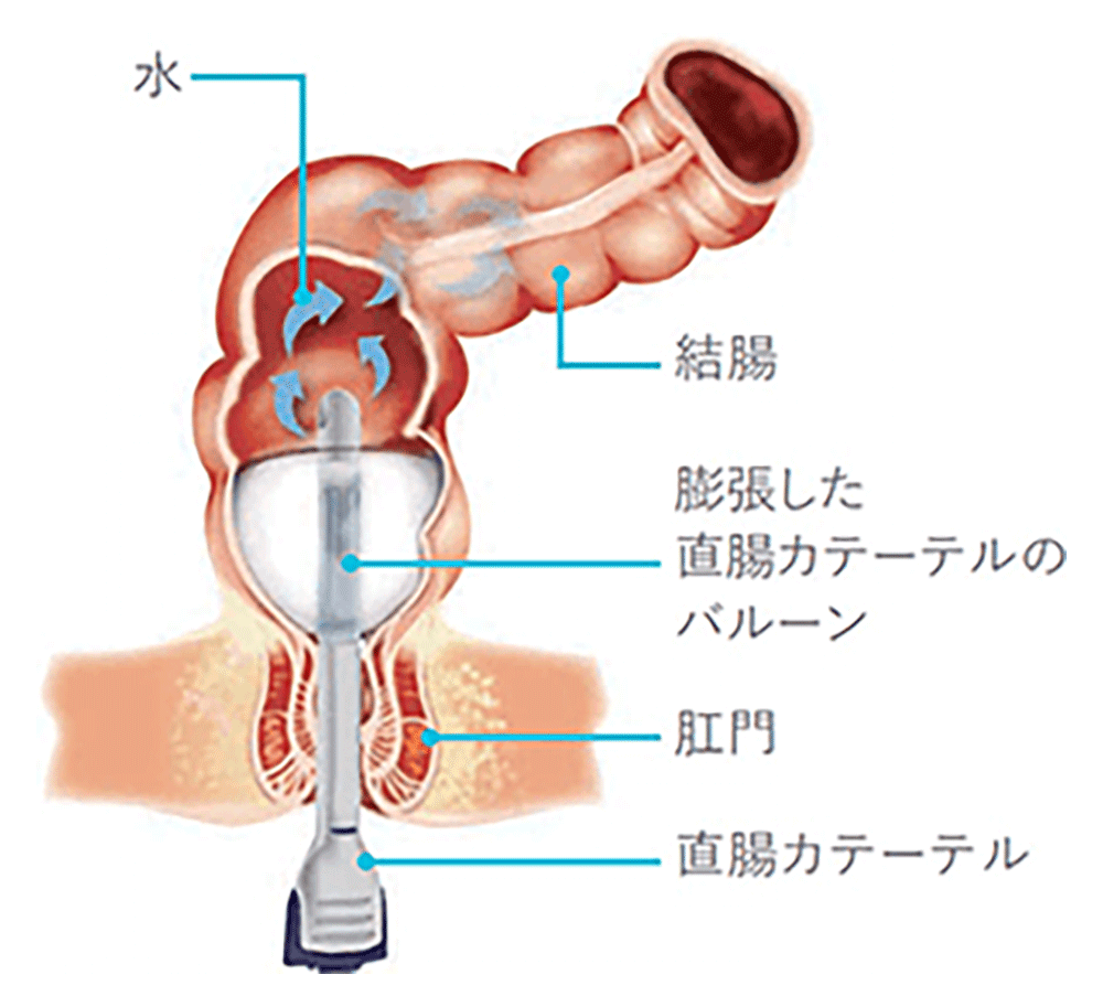 経肛門的洗腸療法