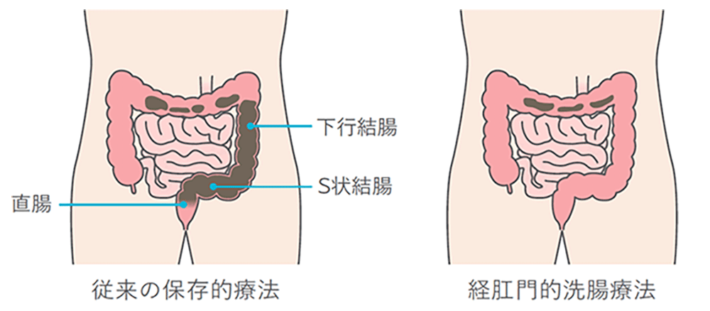 経肛門的洗腸療法の効果